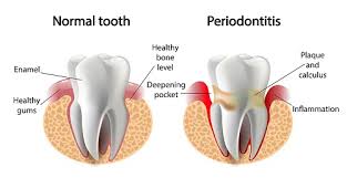 Loose teeth - Perio disease (002)